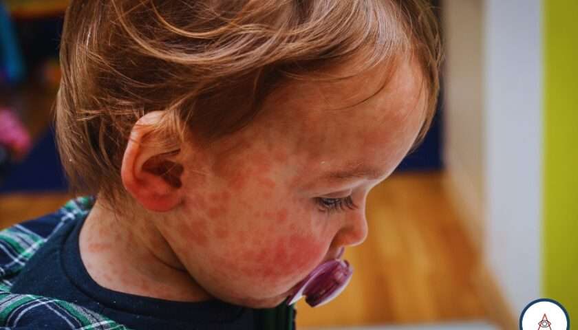 UK Health Agency Issues a Measles Outbreak Risk Alert